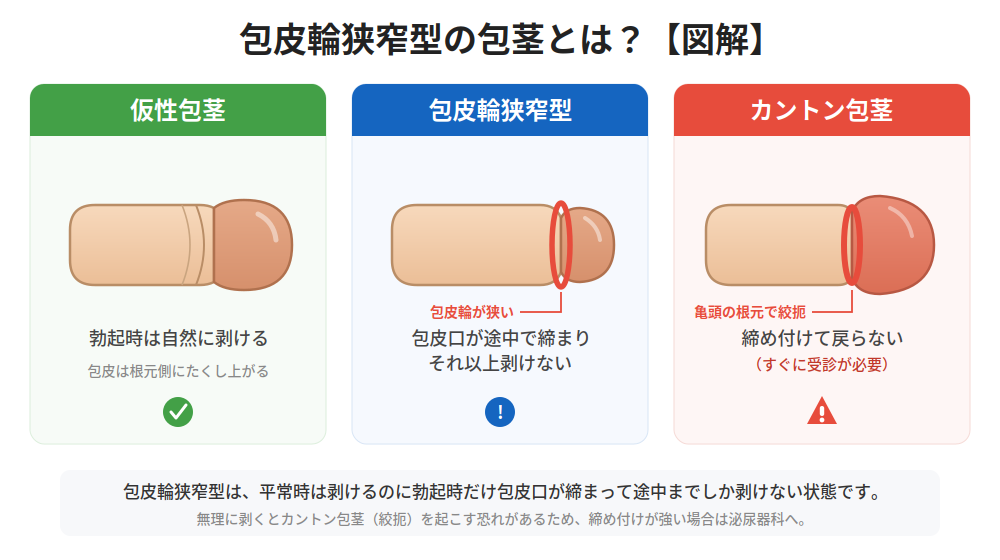 包皮輪狭窄型の包茎の図解（仮性包茎・カントン包茎との違い）