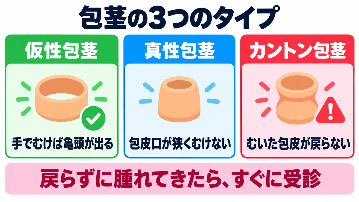 仮性包茎・真性包茎・カントン包茎の違いの図解