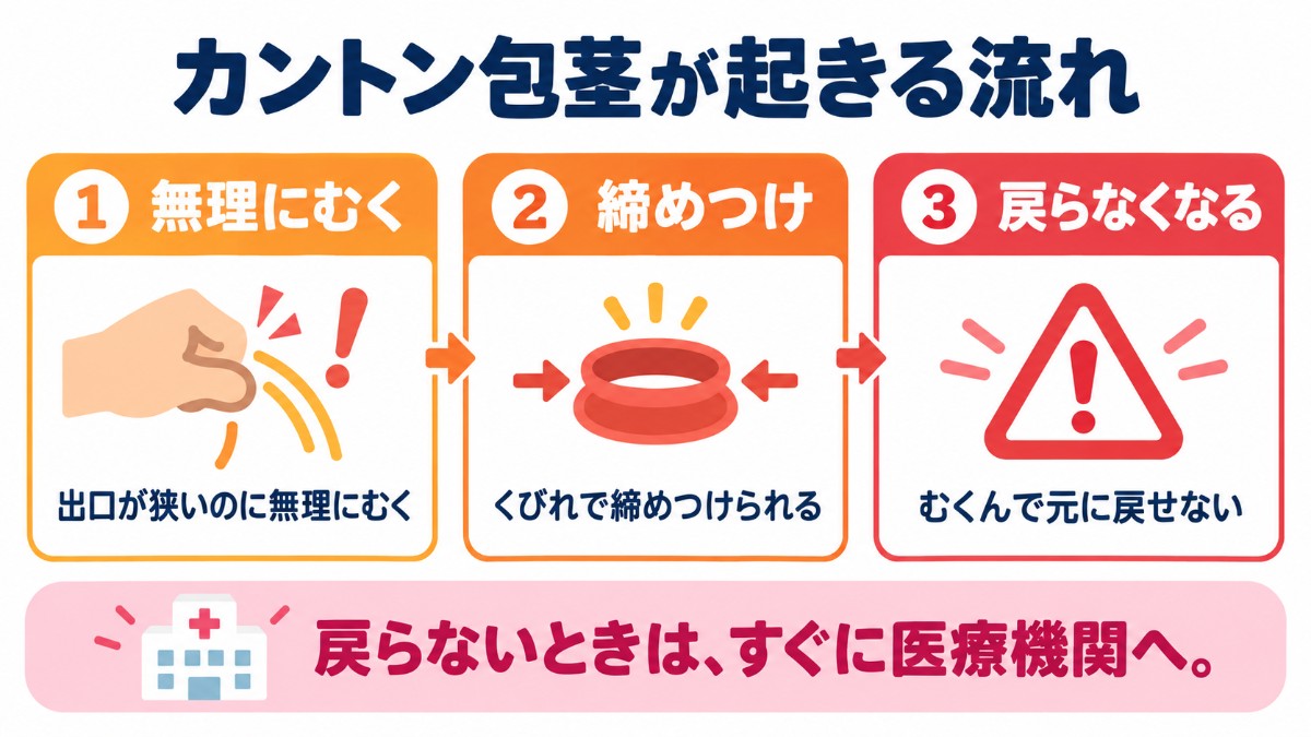カントン包茎が起きる流れ（出口が狭いのに無理にむく、くびれで締めつけられる、むくんで元に戻せない）