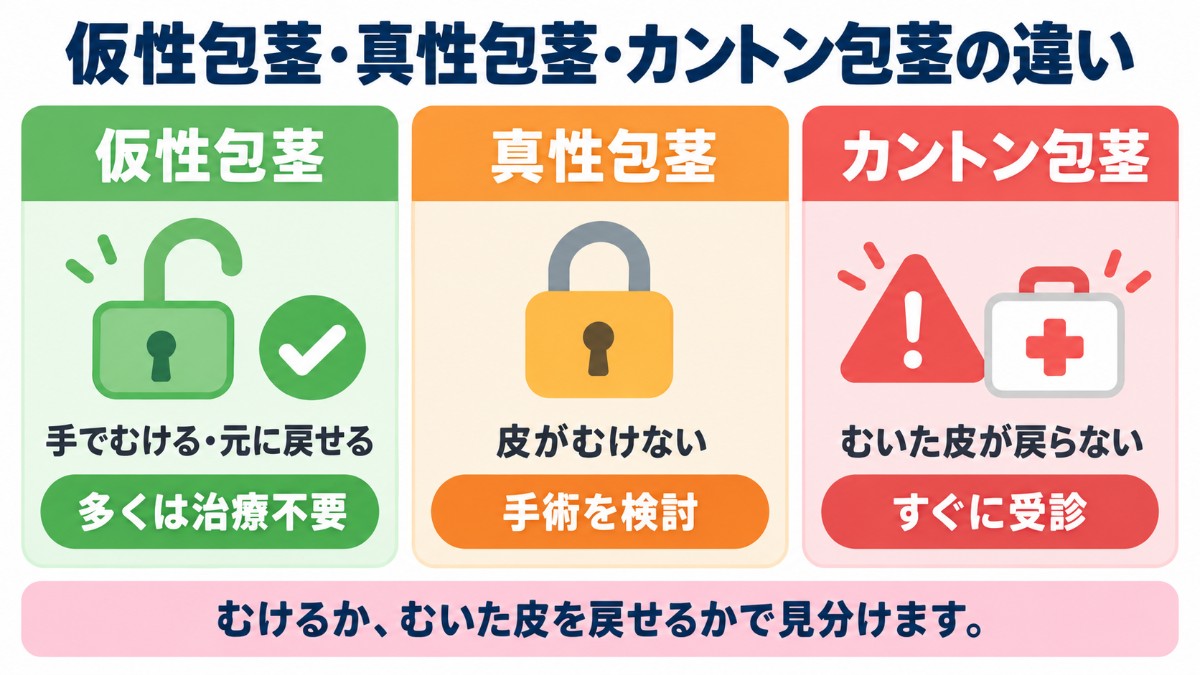 仮性包茎・真性包茎・カントン包茎の違い（仮性包茎は手でむけて元に戻せる、真性包茎は皮がむけない、カントン包茎はむいた皮が戻らない）