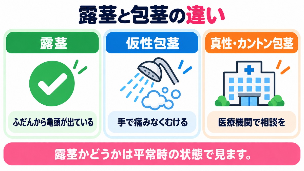 露茎と包茎の違い(露茎はふだんから亀頭が出ている、仮性包茎は手で痛みなくむける、真性・カントン包茎は医療機関で相談)