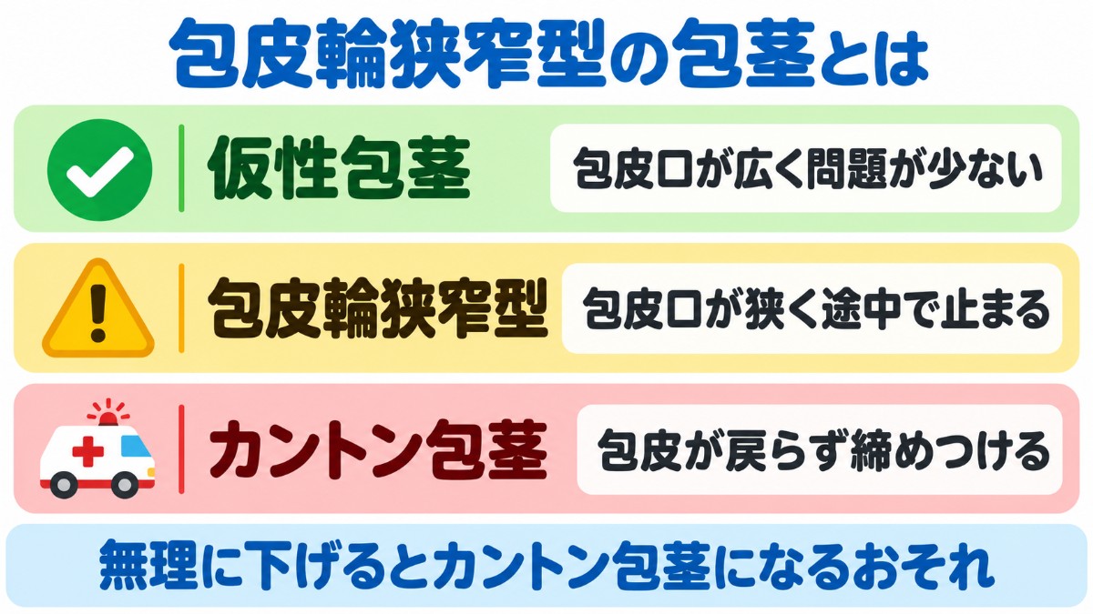 包皮輪狭窄型の包茎を、仮性包茎・カントン包茎と比べ、包皮口の広さと注意点の違いを緑・黄・赤の3段で示した図