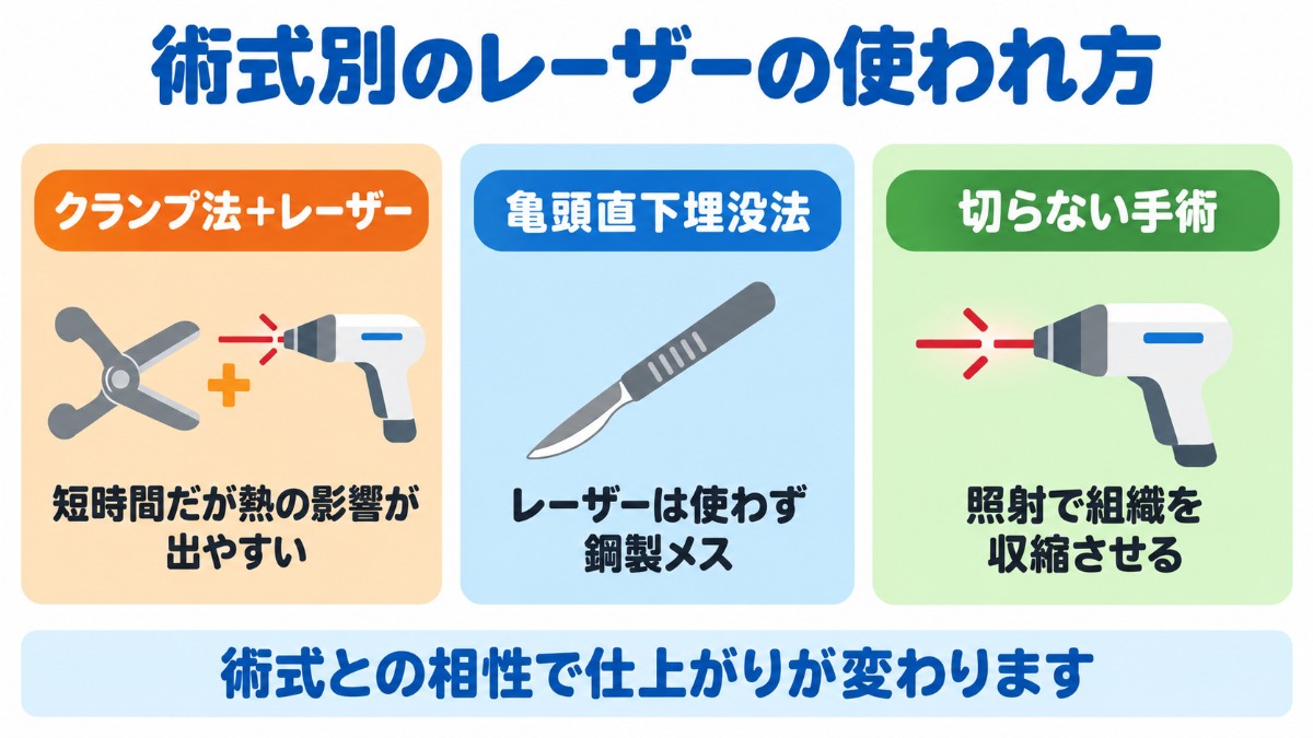 術式によるレーザーの使われ方を、熱の影響が出やすいクランプ法＋レーザーメス、レーザーを使わず鋼製メスで切開する亀頭直下埋没法、照射で組織を収縮させる切らない手術の3つで比べた図